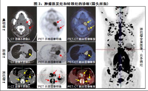 检查癌症最先进的仪器,目前最先进的查癌症的设备是