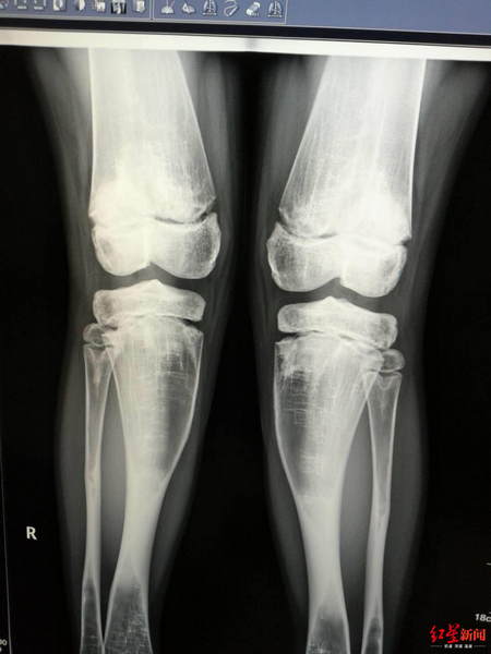 女孩确诊骨瘤妈妈发抖,10岁女孩鼻窦炎反复