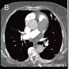 肺动脉分支充盈欠佳是肺栓塞吗,肺动脉缺损不可逆