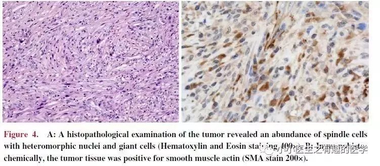 肺动脉分支充盈欠佳是肺栓塞吗,肺动脉缺损不可逆