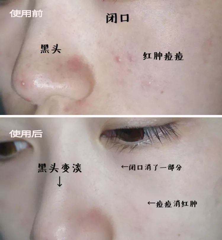 脸上搓出3斤泥！难怪又黄又暗又黑头！10秒给脸蛋“剥壳”，厉害