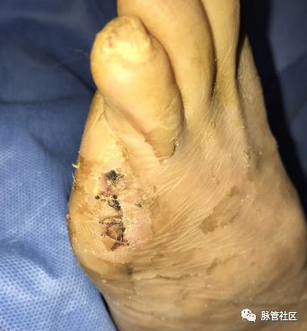 足部溃疡是什么症状,杏林微科普冬季手足皲裂怎么办