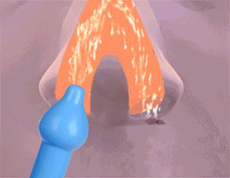 成人鼻子堵又有清鼻涕小妙招,鼻子堵流鼻涕怎么快速解决小妙招