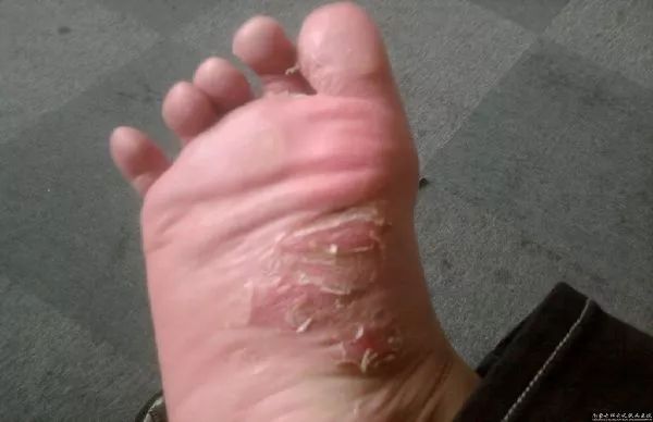 足癣冷知识,杏林微科普预防秋燥的方法