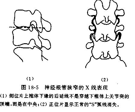 一分钟带你了解腰椎狭窄,椎管狭窄症知识大全