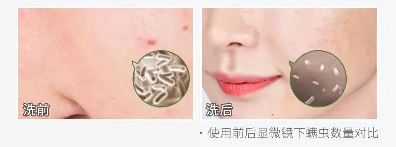 可美金箔祛痘螨虫皂,除螨皂能祛螨虫吗