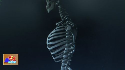 胸廓畸形矫正后会反弹吗,胸廓畸形矫正术后恢复