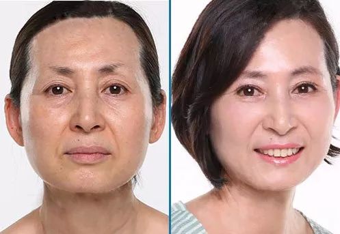 解决皱纹色斑粗糙干燥就用这一套,淡化各种皱纹特别快的好方法