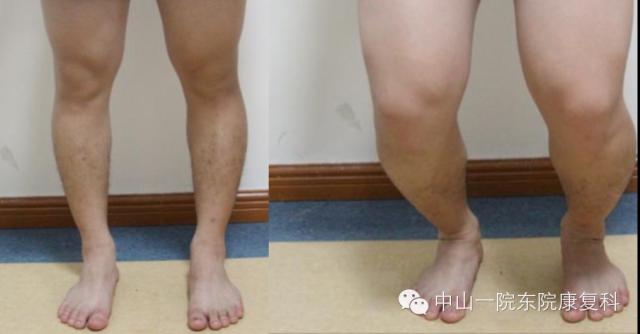 筋膜的康复训练方法,12条筋膜链解析及治疗手法