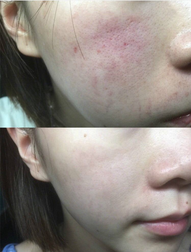 敏感肌红血丝反复怎么修复,敏感肌泛红有红血丝如何修复