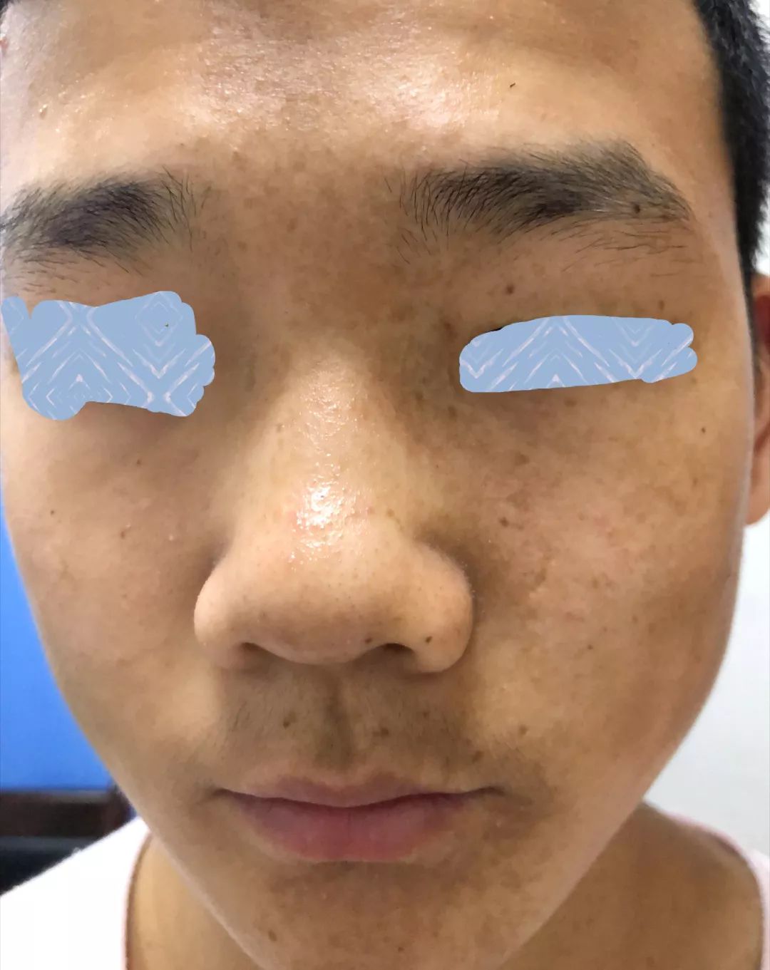 雀斑样痣和雀斑的区别有哪些,雀斑和青褐色痣