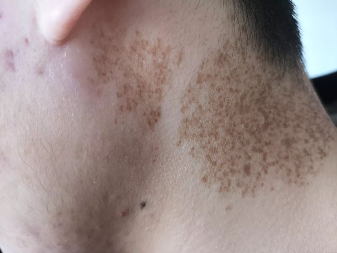 雀斑样痣和雀斑的区别有哪些,雀斑和青褐色痣