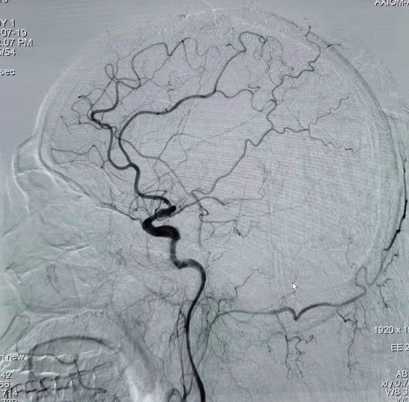 Reco特约·第10期｜国产组合助力取栓“一把通”——Ewata球囊导引导管联合Reco支架取栓分享