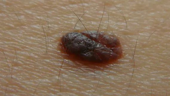 突然长痣是不是出了什么问题知乎,女人左手背突然长痣代表什么