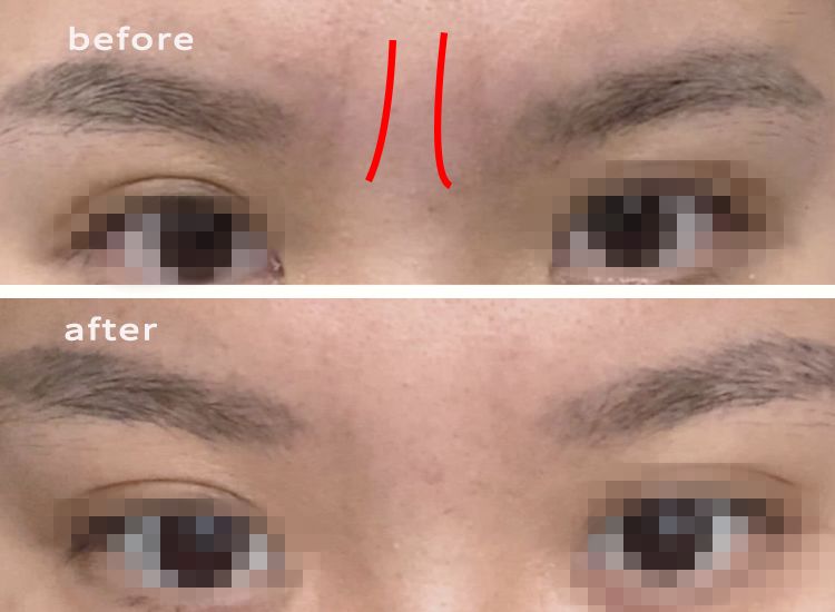 法令纹又黑又长,法令纹又深又长好吗