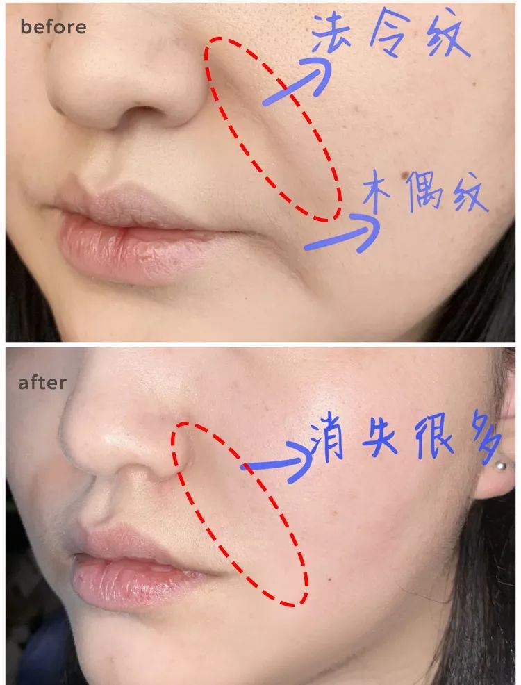 法令纹又黑又长,法令纹又深又长好吗