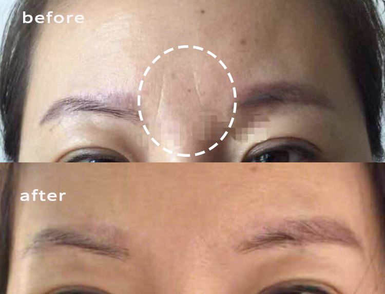 三十岁就有眉间纹法令纹怎么办,30岁法令纹眉心纹深