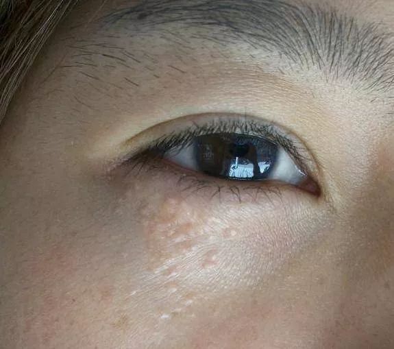 为什么脸上的痘痘那么难消,你脸上的痘痘是螨虫痘吗