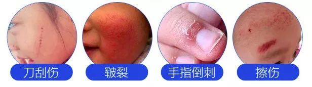 比创可贴好用,最好用的液体创可贴