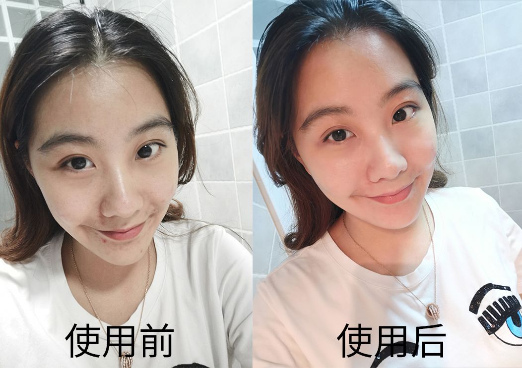 可美金箔祛痘螨虫皂,除螨皂能祛螨虫吗