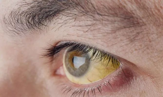 高胆红素脑病四大临床表现,胆红素高症状有哪些