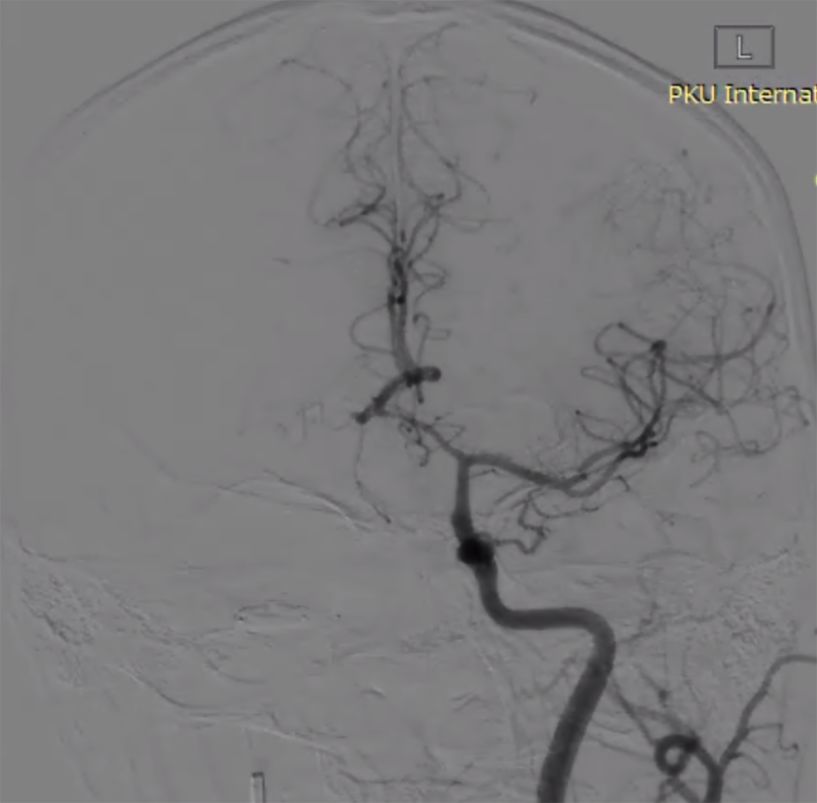物华天宝·第7期｜脑部长型巨大夹层动脉瘤的4个密网支架桥接治疗复查治愈（附复查CTA结果）