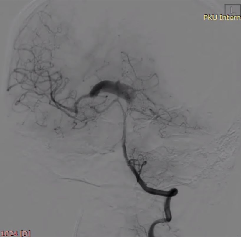 物华天宝·第7期｜脑部长型巨大夹层动脉瘤的4个密网支架桥接治疗复查治愈（附复查CTA结果）