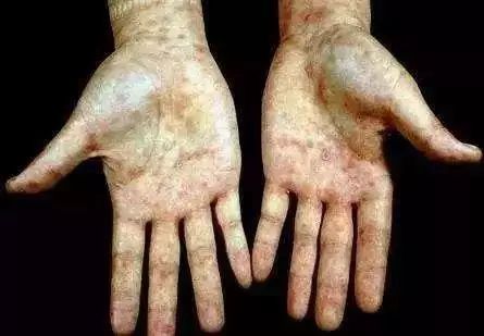 诺贝尔奖免疫治疗法,以毒攻毒效果甚微