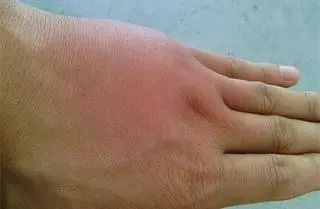 白药喷雾剂治静脉炎吗,白药气雾剂治扭伤效果怎么样