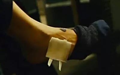 脚后跟黑痣癌变概率大吗,男子脚底长黑痣