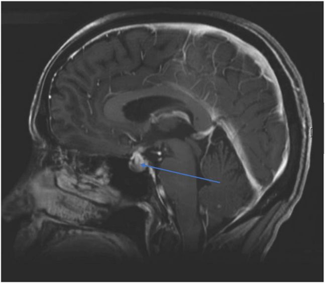 进言献策|免疫检查点*制剂抑**之内分泌不良反应