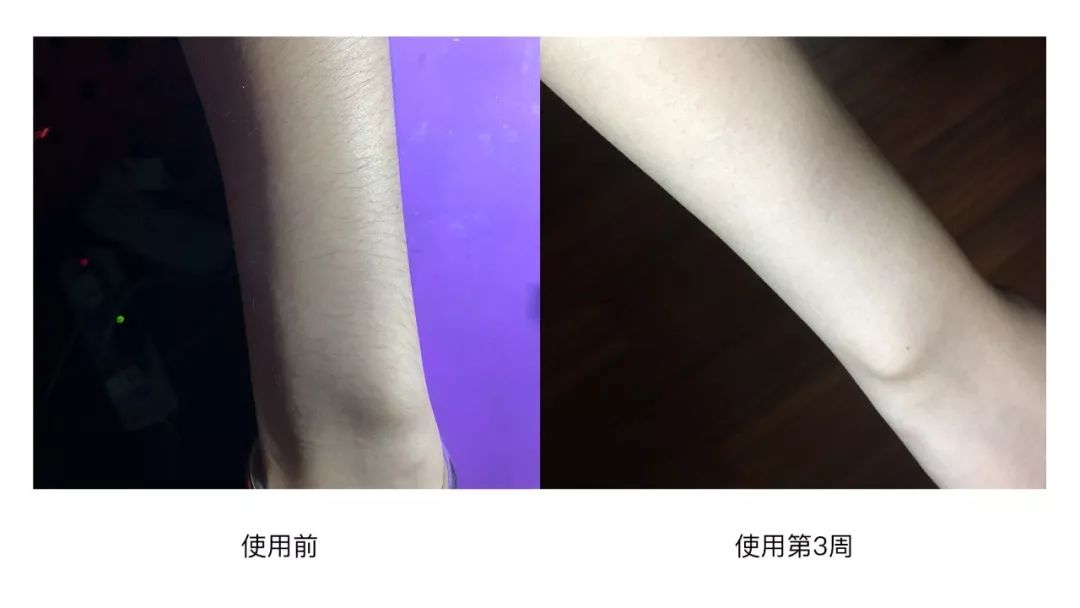 不要错过脱毛好季节,别再错过脱毛最佳季节