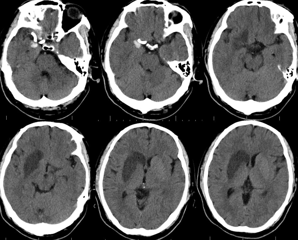 治疗颅内动脉瘤新型密网支架,pipeline治疗椎动脉夹层动脉瘤