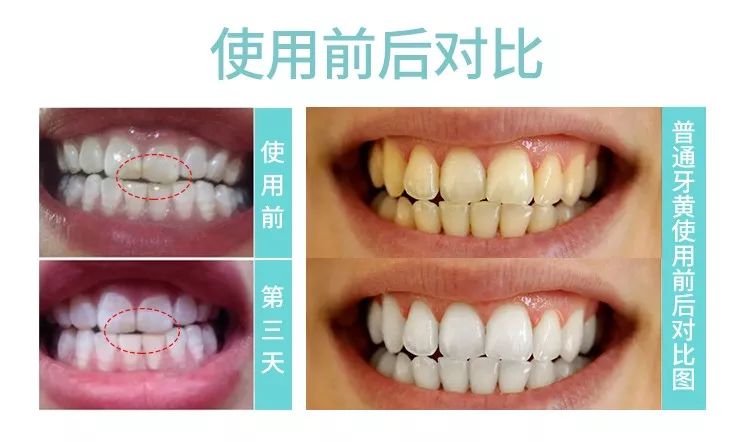 去除黄牙牙垢的牙膏,去口臭黄牙牙垢的牙膏