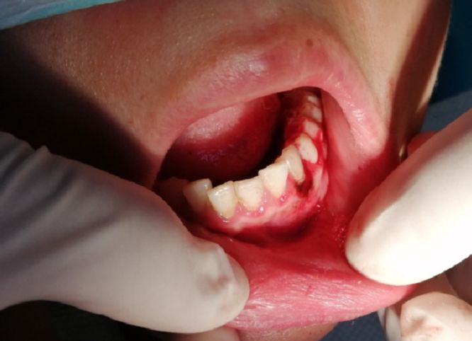 孕27周牙龈肿痛怎么办,准妈妈孕晚期出现牙龈瘤