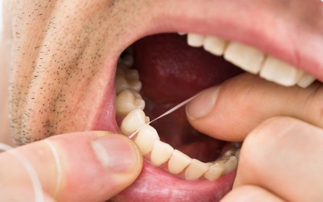 洗牙神器是真的管用,洗牙神器去牙结石永久有效果