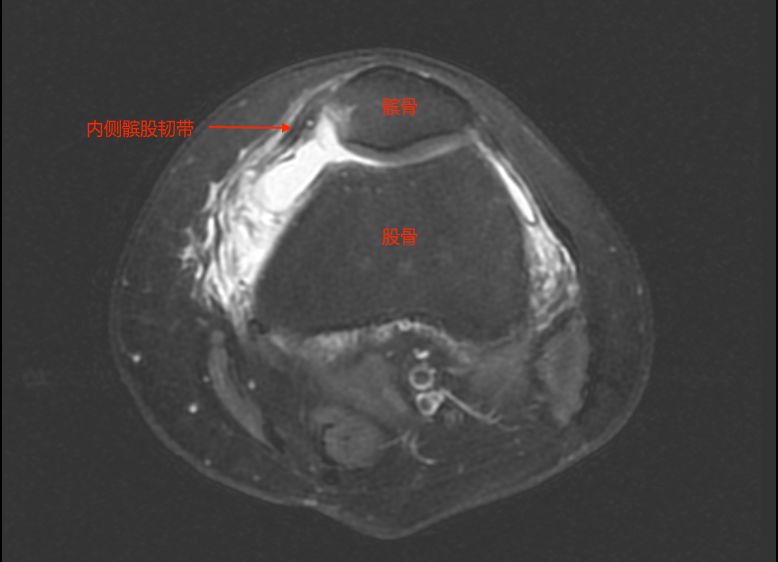 摔了一跤骨裂要做微创手术,摔一跤脚骨折手术