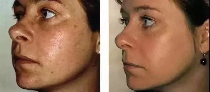 去黑头角质平价水乳,去黑头日本洗面奶