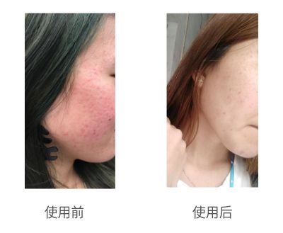 哪个牌子的壬二酸凝胶好,首博尔壬二酸清痘凝胶副作用