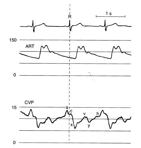 围术期中心静脉监测的专家共识（2017版）