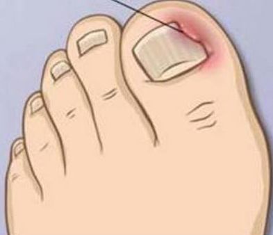 好严重的甲沟炎,离谱的甲沟炎