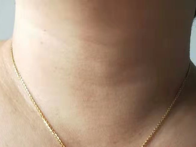 腔镜甲状腺外科手术简介,腔镜甲状腺手术适应症及美容效果