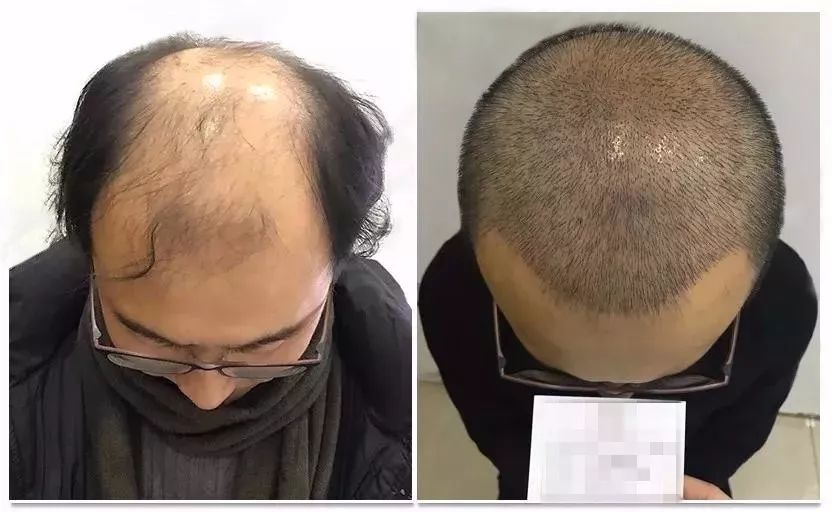 报道来了！28岁小伙“秃”成50岁？过年前抓紧……芜湖全面启动