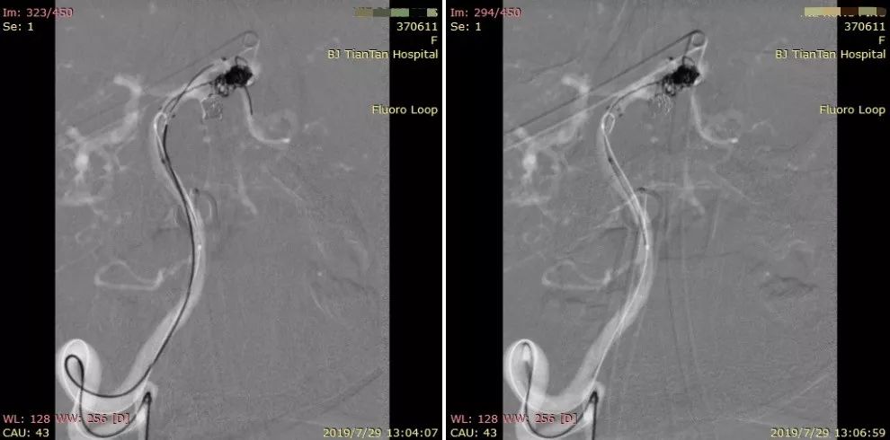 物华天宝·第12期｜复发多发动脉瘤合并烟雾病的支架辅助弹簧圈栓塞治疗