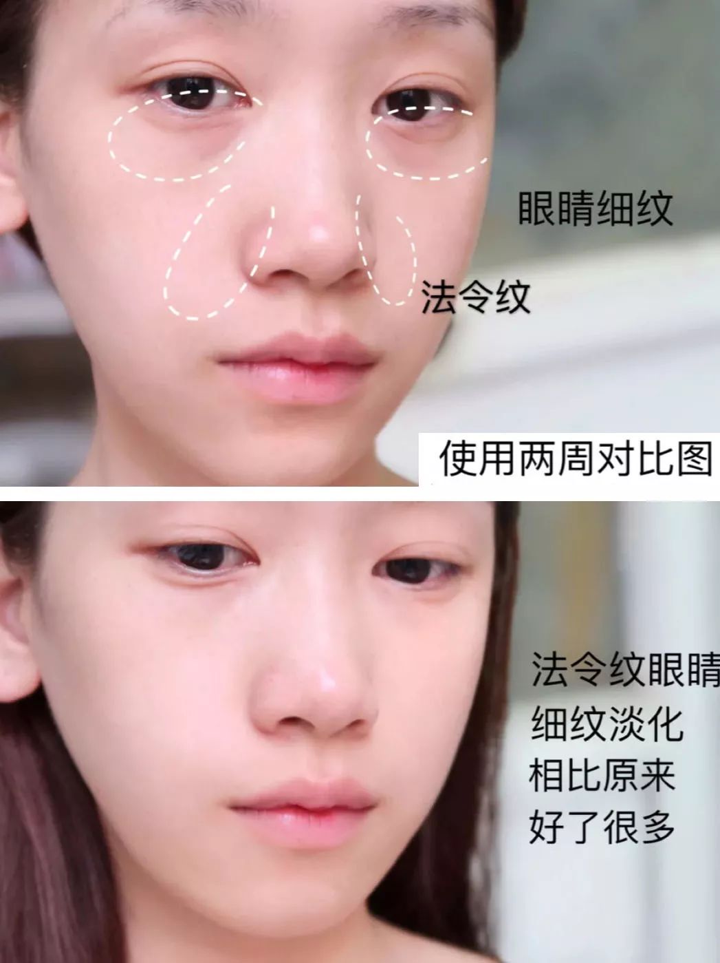 法令纹和眼纹怎么才能有效改善,法令纹贴眼贴有用吗