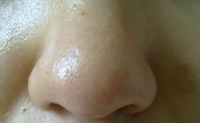 草莓鼻去黑头好物推荐使用,草莓鼻去黑头导出液