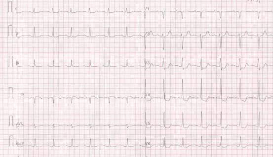 专栏丨贾卫滨：心电图“掉头”现象的定义与诊断特征（1）
