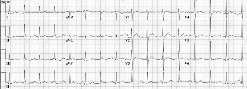 甲亢导致心率过速如何治疗,甲亢导致心率过快怎么治疗