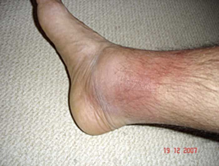 秋水仙碱真的很可怕吗,秋水仙碱已经禁用了吗