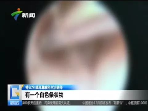 奇葩！男子塞大蒜治中耳炎，2个月后发酵变蒜泥